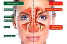 Geniz Akıntısı Nedenleri Geniz Akıntısı Nedenleri